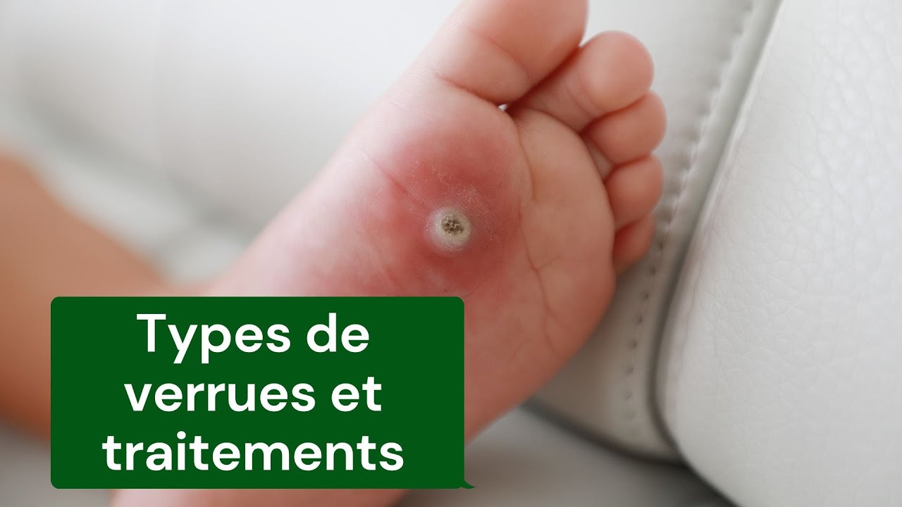 Types de verrues et traitements