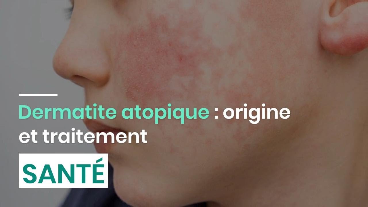 Dermatite atopique : origine et traitement