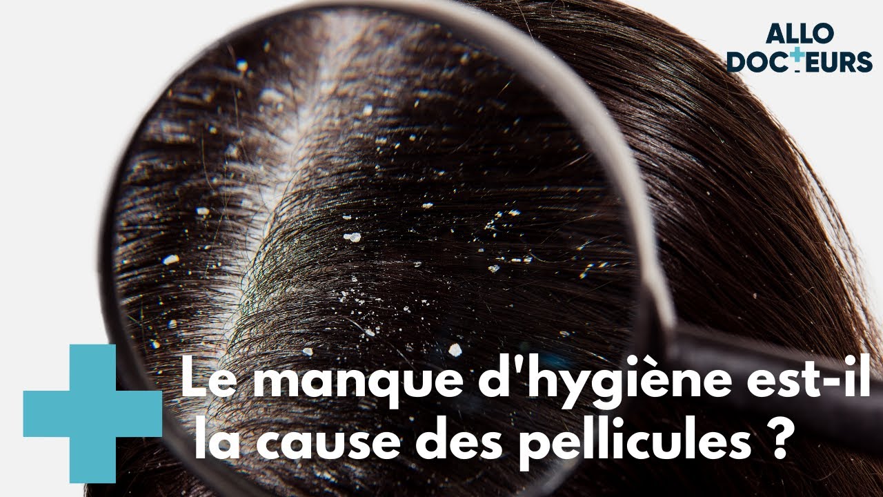 Tout savoir sur les pellicules - AlloDocteurs